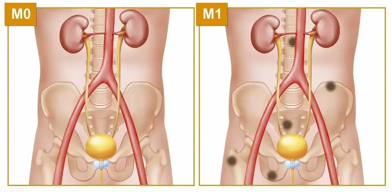 预防尿结石，你都吃对了吗？