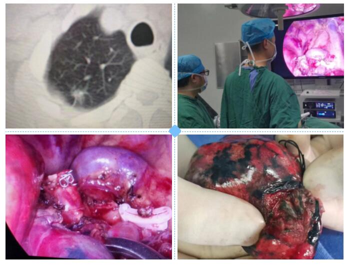 宜春学院第一附属医院万载县人民医院成功开展胸腔镜肺段切除术