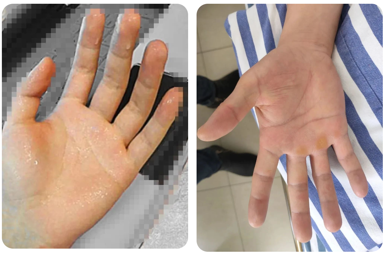 新技术！手汗症患者福音！宜春学院第一附属医院（万载县人民医院）成功开展胸腔镜下胸交感神经切断术