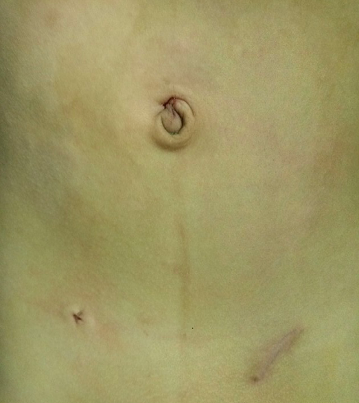 &ldquo;三比三争&rdquo;践行动 | &ldquo;勿以'疝'小而不为&rdquo;&mdash;&mdash;腹腔镜小儿疝手术