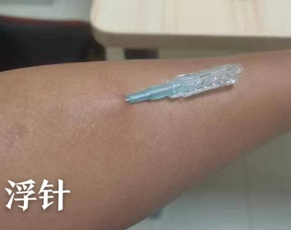 &ldquo;小&rdquo;浮针，&rdquo;大&rdquo;作用，一招助您快速解决痛苦！