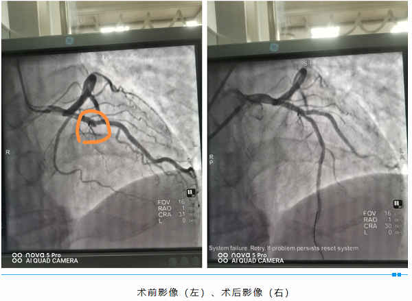与死神赛跑，为生命接力&mdash;&mdash;我院成功 抢救一名急性心肌梗死患者