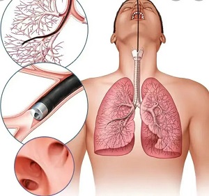 【健康科普】深入肺部的&ldquo;火眼金睛&rdquo;&mdash;&mdash;支气管镜