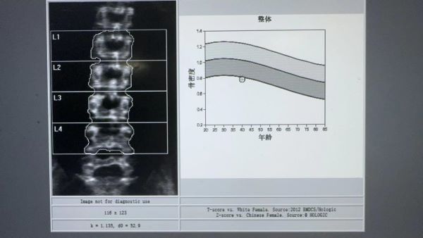 【健康科普】带您了解骨密度