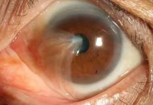 【健康科普】警惕眼睛里的小翅膀&mdash;&mdash;翼状胬肉