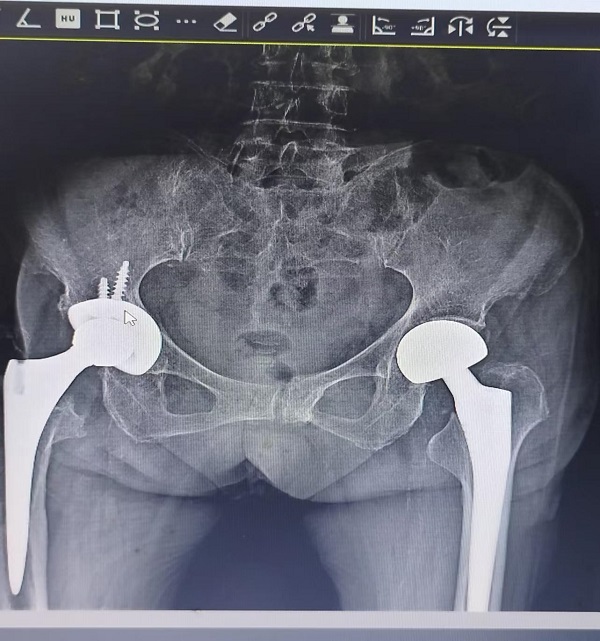 拒绝&ldquo;人生最后一次骨折&rdquo;，高龄老年骨科病人重获&ldquo;新生&rdquo;