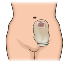 关爱造口患者，重塑生命尊严&mdash;&mdash;宜春学院第一附属医院 万载县人民医院造口护理诊室暖心开诊！