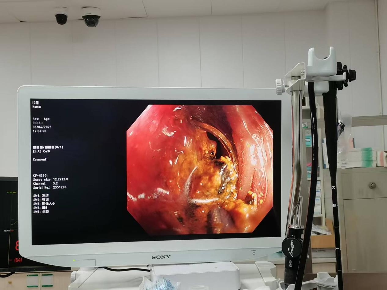 【一次最好的就医体验】我院消化内科成功为高龄胃大部切除患者实施ERCP取石术